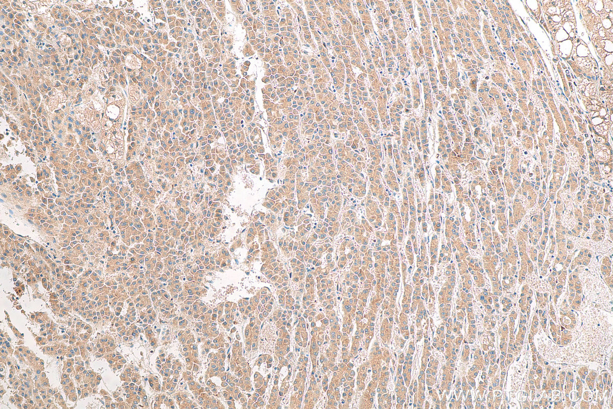 IHC staining of human liver cancer using 81471-1-RR