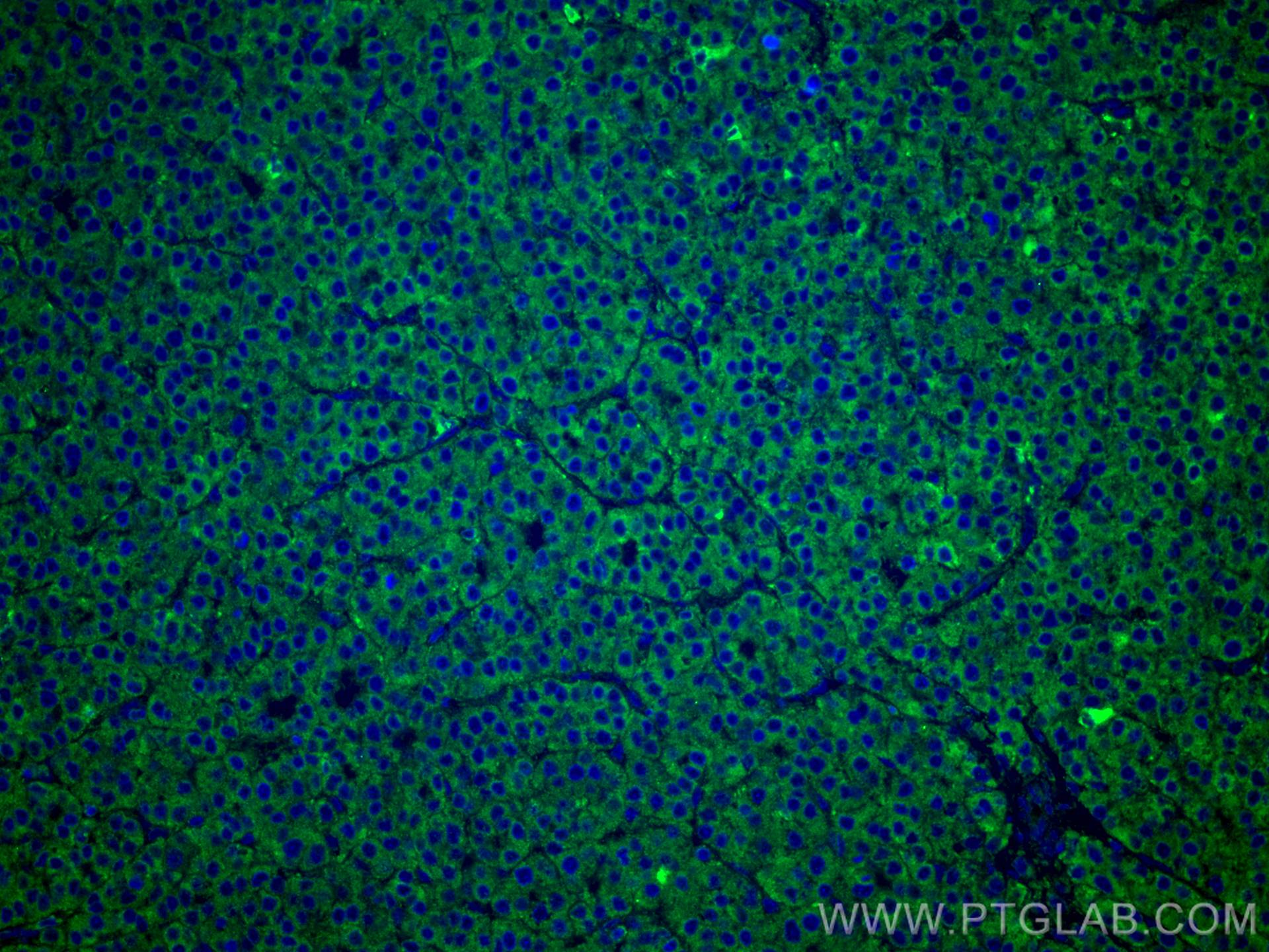 IF Staining of human liver cancer using 67251-1-Ig