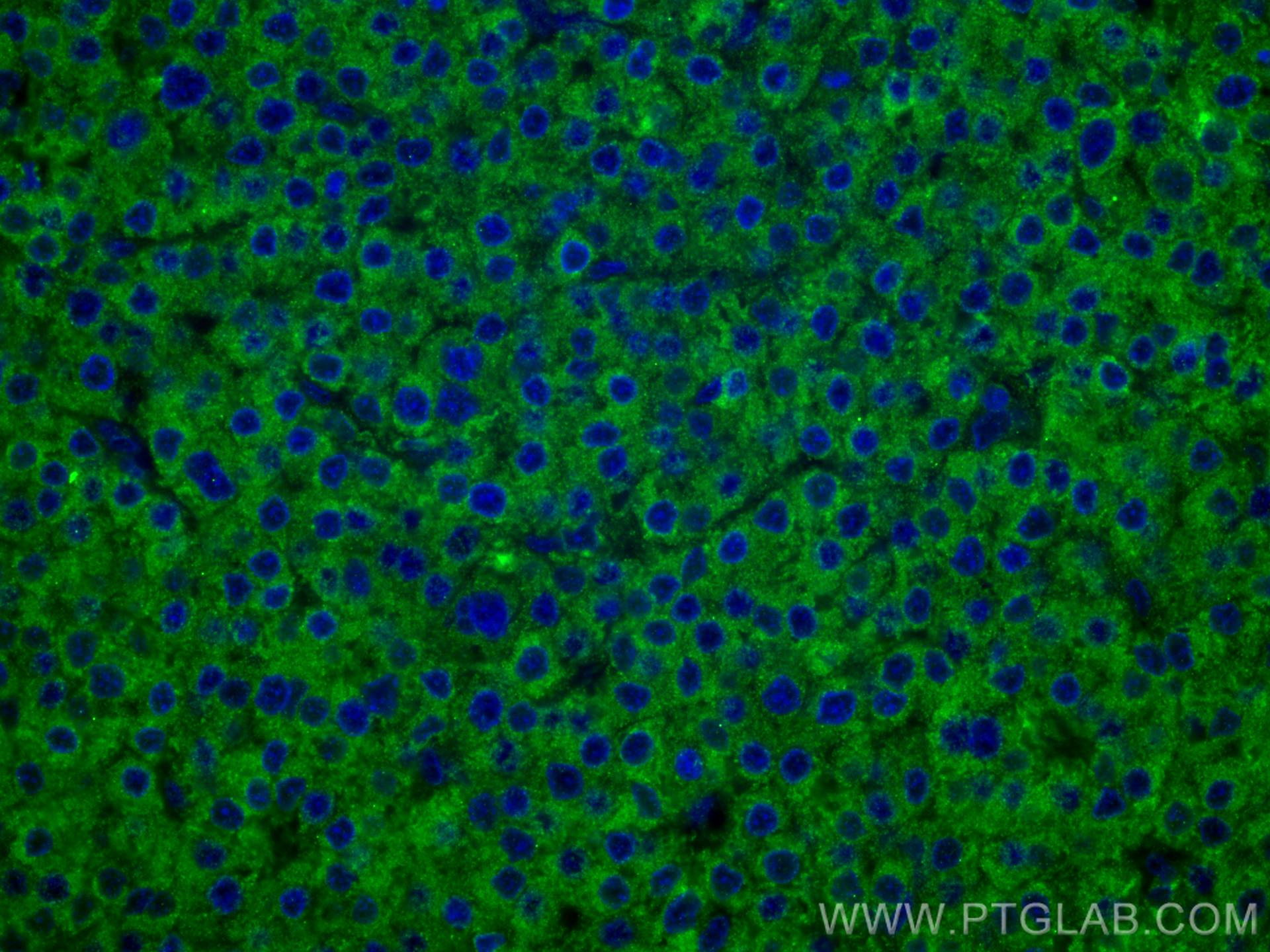 IF Staining of human liver cancer using 67251-1-Ig