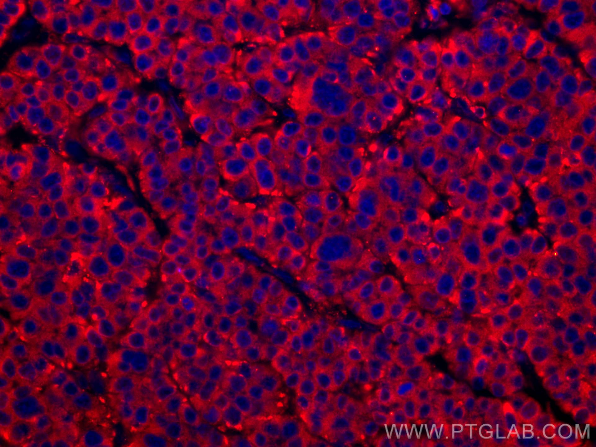 IF Staining of human liver cancer using CL594-67251