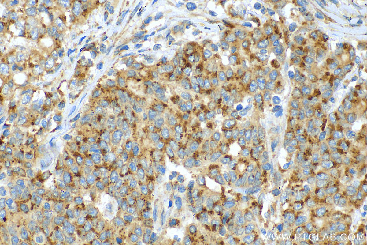 IHC staining of human stomach cancer using 30080-1-AP