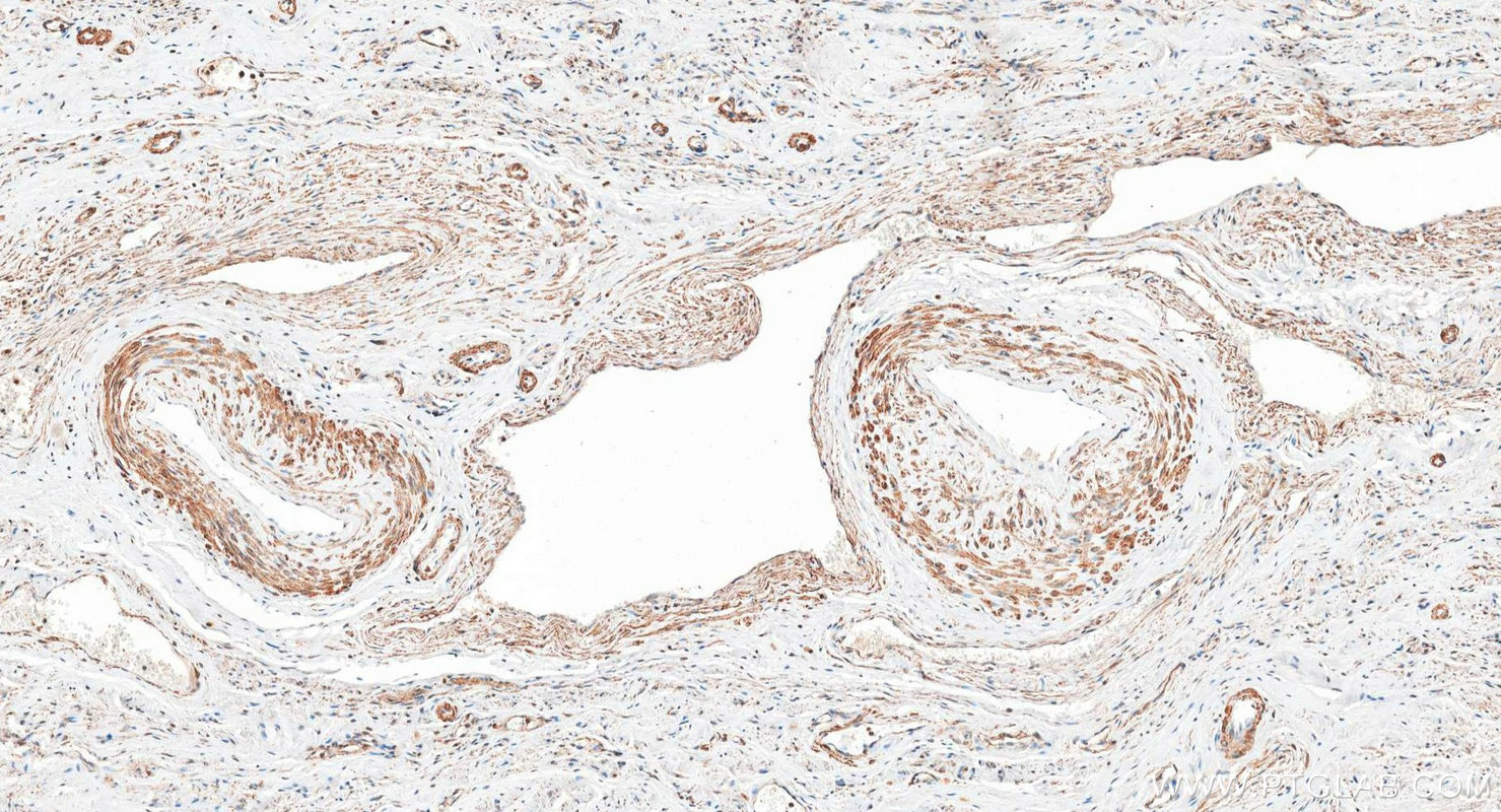 IHC staining of human cervical cancer using 28519-1-AP