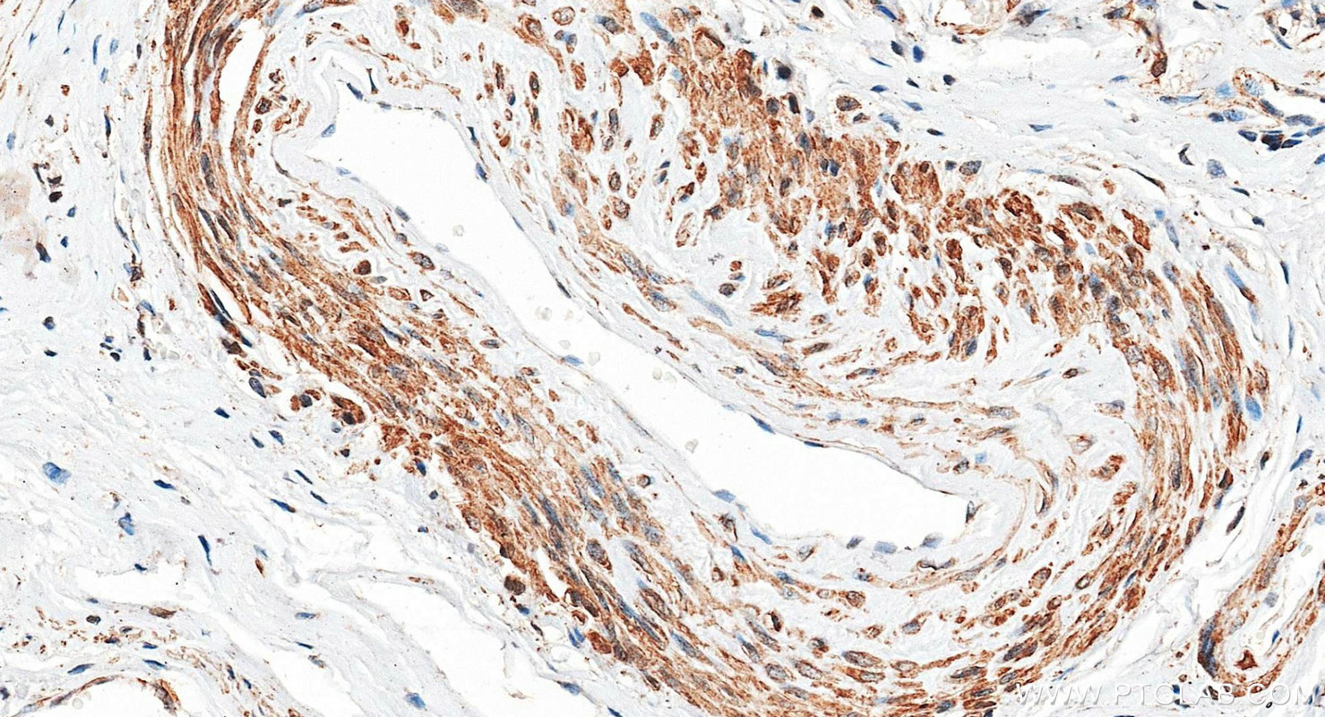 IHC staining of human cervical cancer using 28519-1-AP