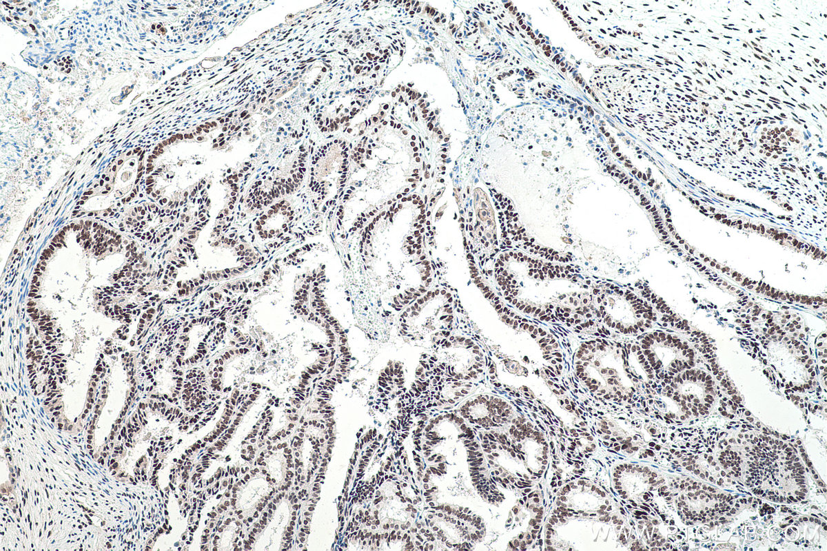 IHC staining of human ovary tumor using 11570-1-AP IHC staining of human ovary tumor using 11570-1-AP
