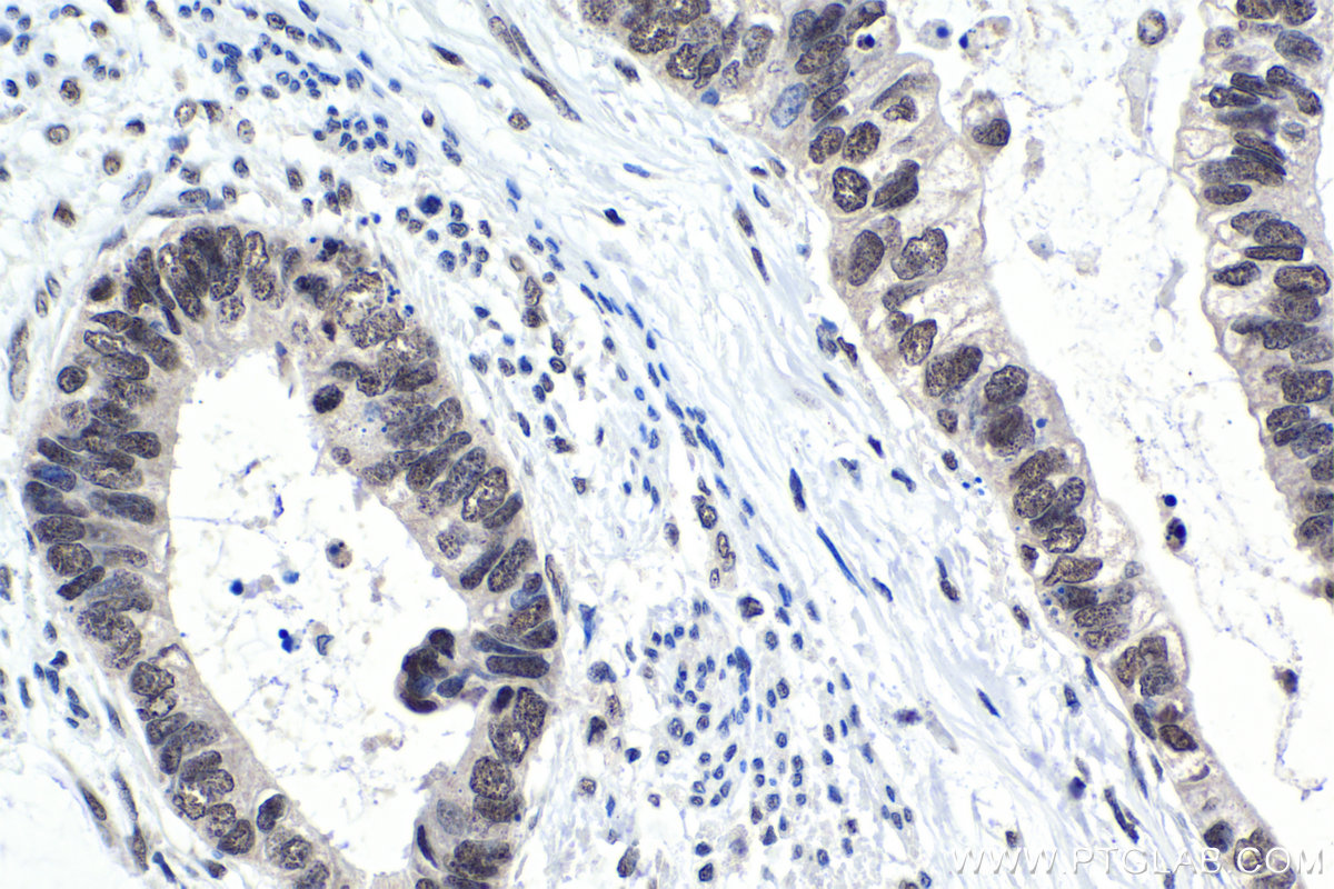 IHC staining of human urothelial carcinoma using 10131-1-AP