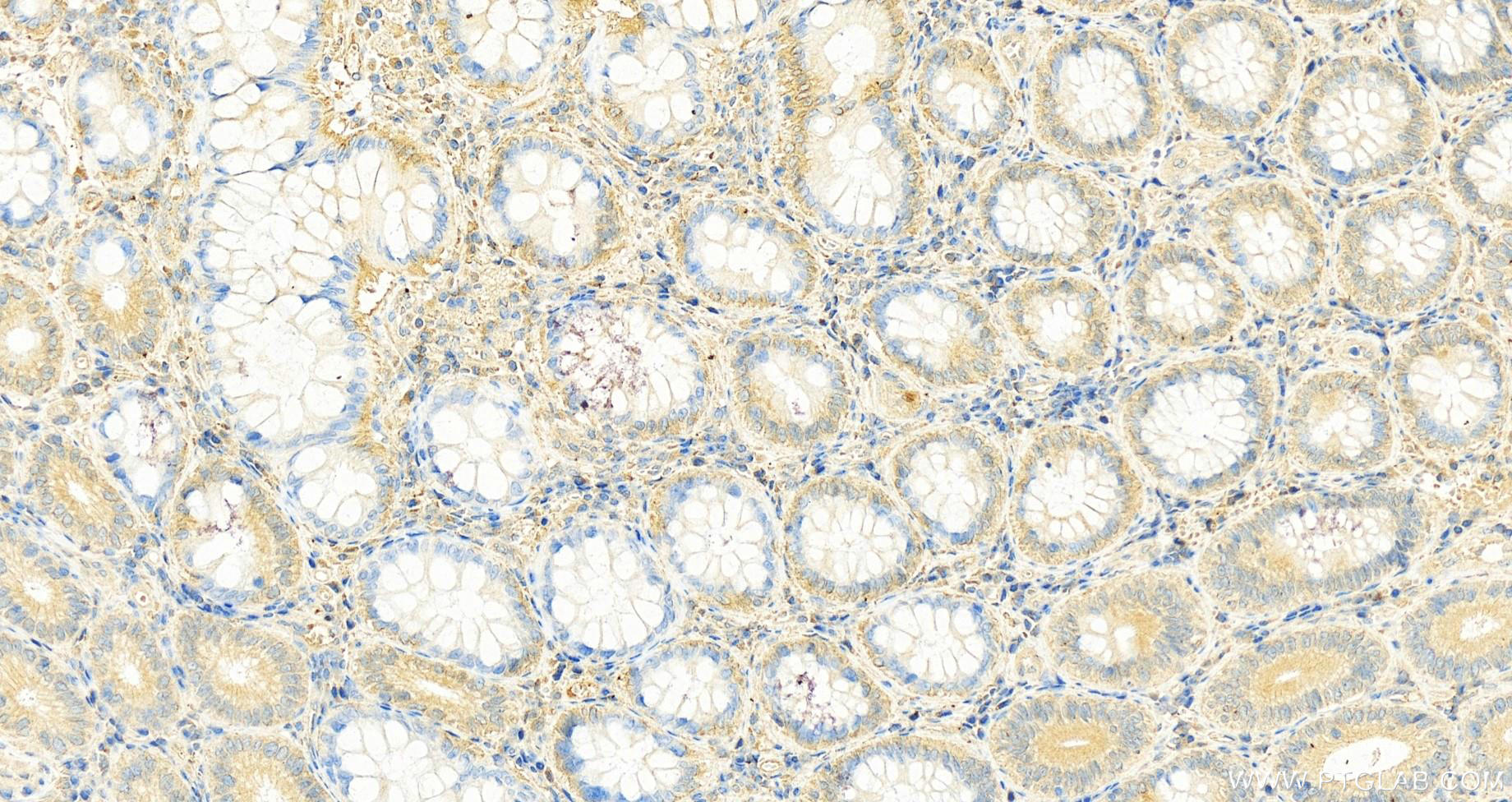 IHC staining of human colon cancer using 67344-1-Ig