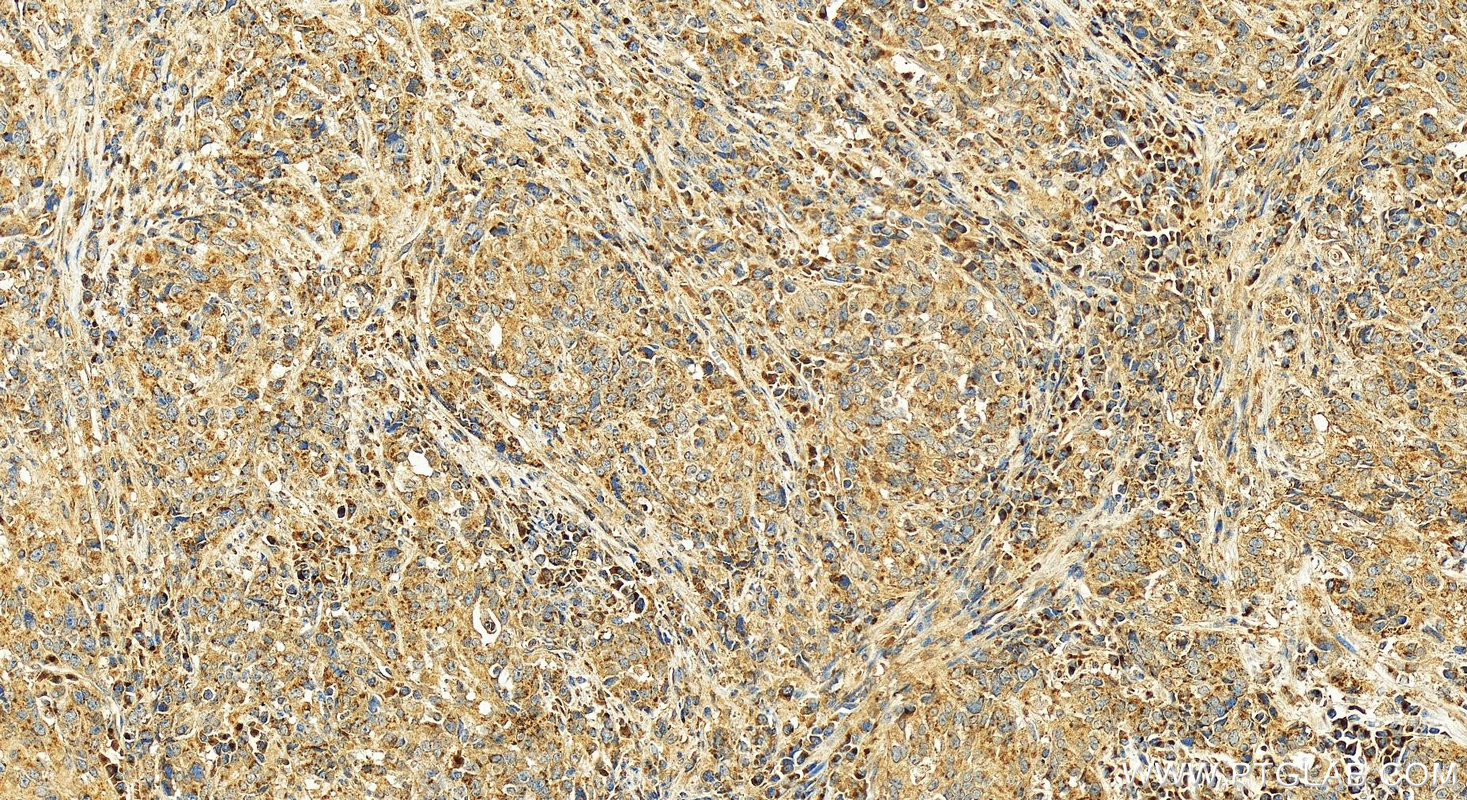 IHC staining of human stomach cancer using 12560-1-AP
