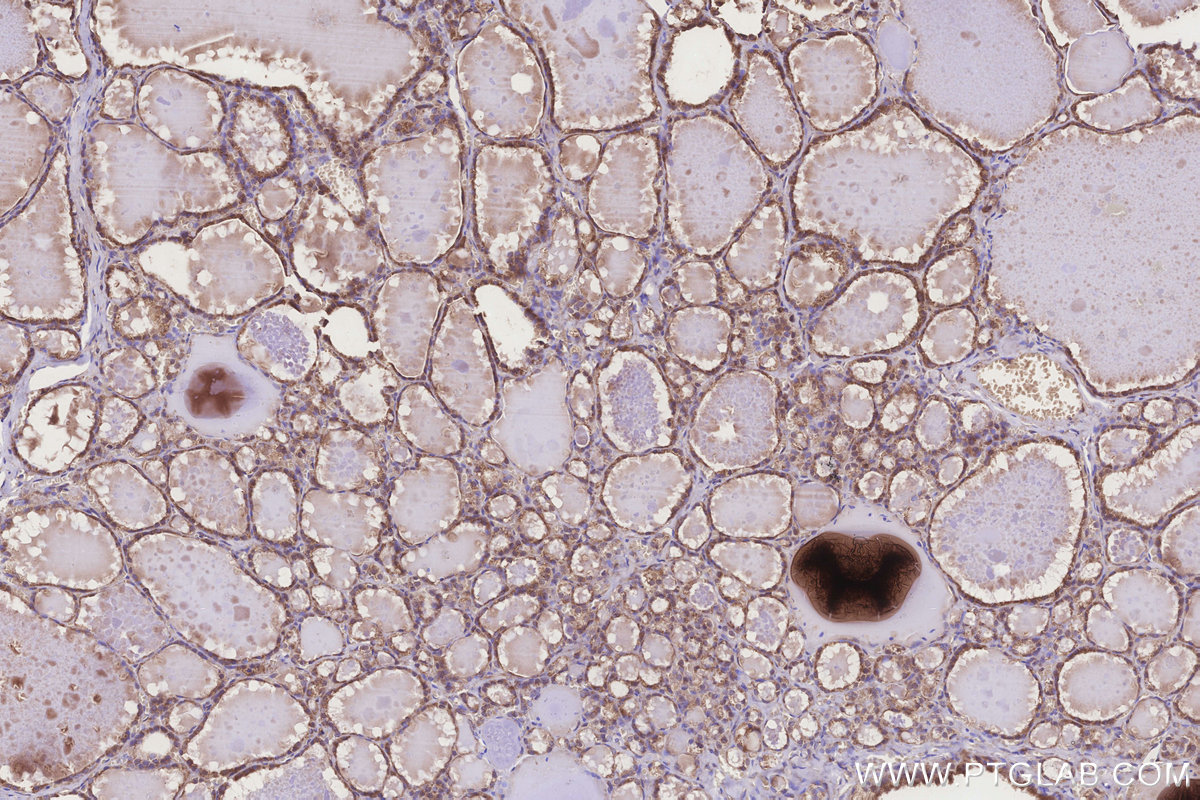 IHC staining of human thyroid cancer using 12560-1-AP