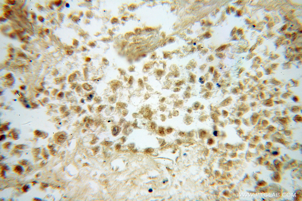 IHC staining of human lung cancer using 12560-1-AP