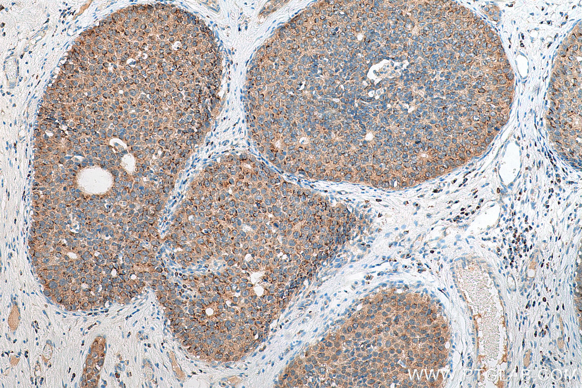 IHC staining of human breast cancer using 29430-1-AP