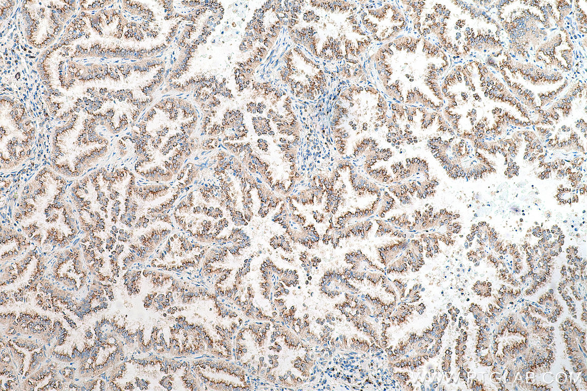 IHC staining of human lung cancer using 29430-1-AP