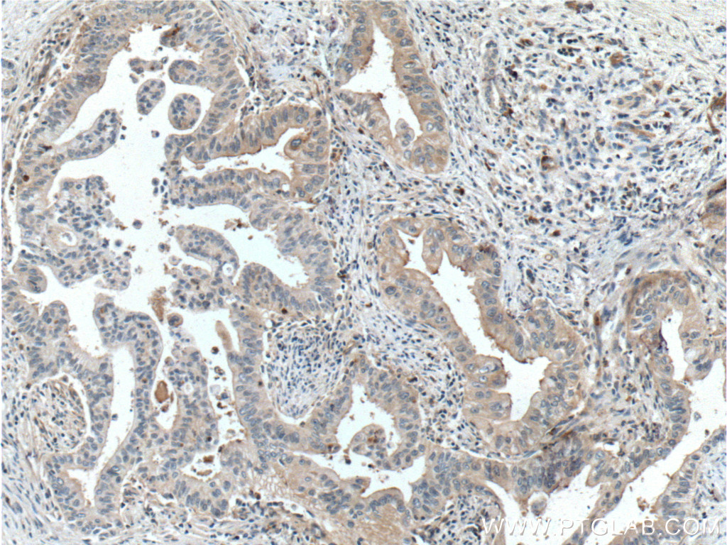 IHC staining of human pancreas cancer using 55093-1-AP