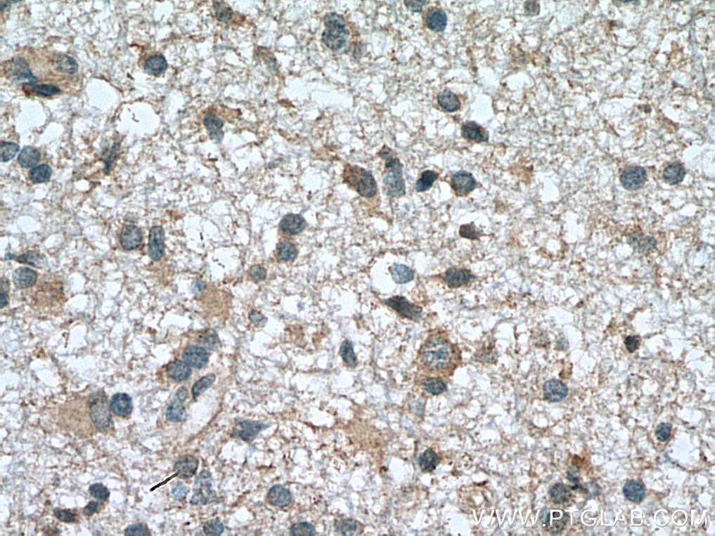 IHC staining of human gliomas using 13865-1-AP