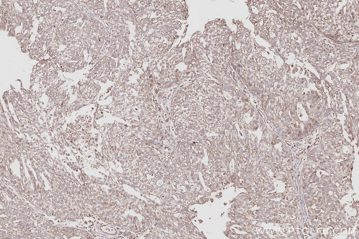 IHC staining of human ovary cancer using 16368-1-AP IHC staining of human ovary cancer using 16368-1-AP