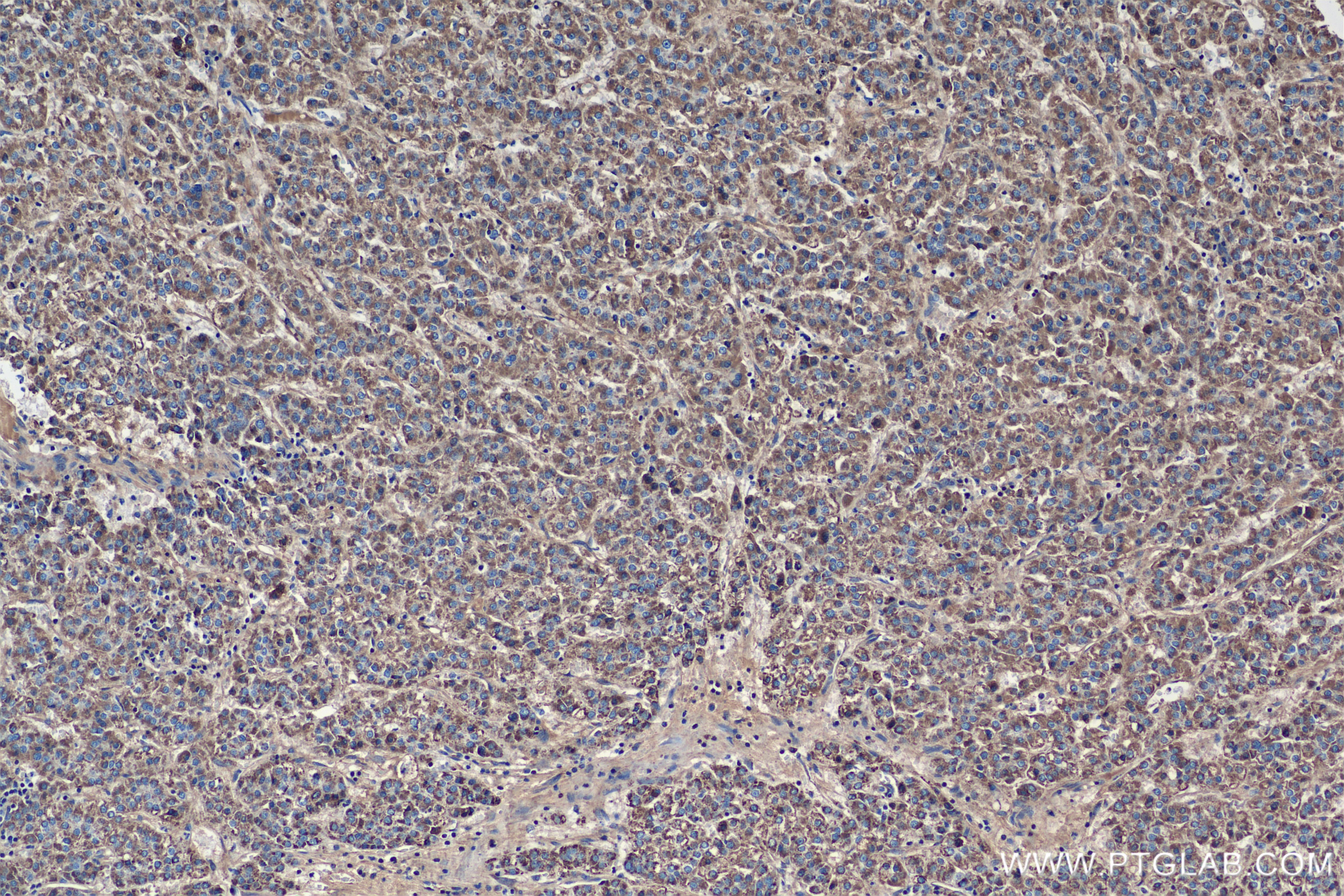 IHC staining of Human Hepatocellular cancer using 84533-4-RR