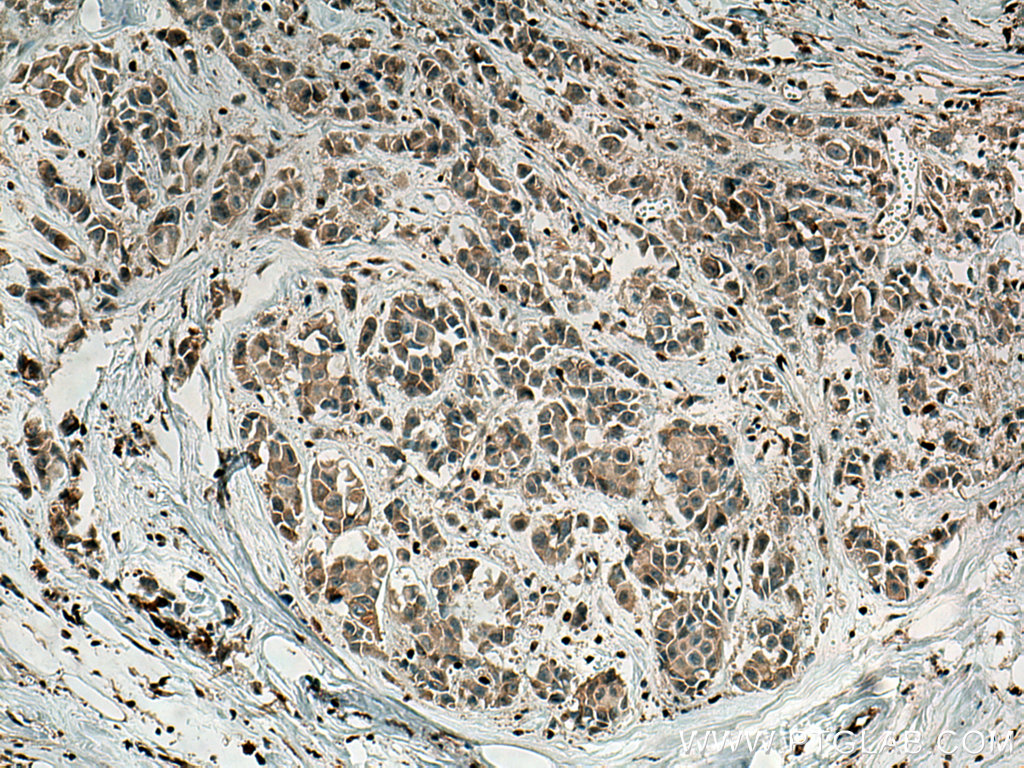 IHC staining of human breast cancer using 26935-1-AP