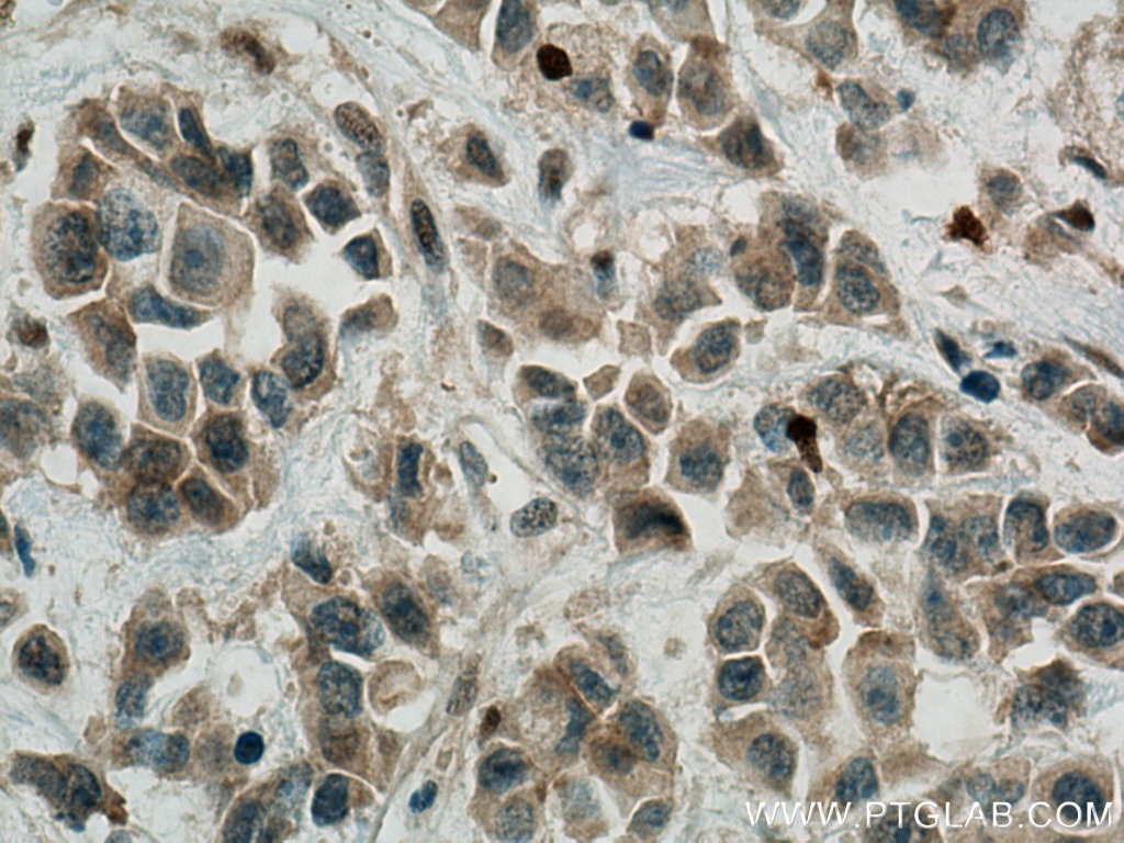IHC staining of human breast cancer using 26935-1-AP