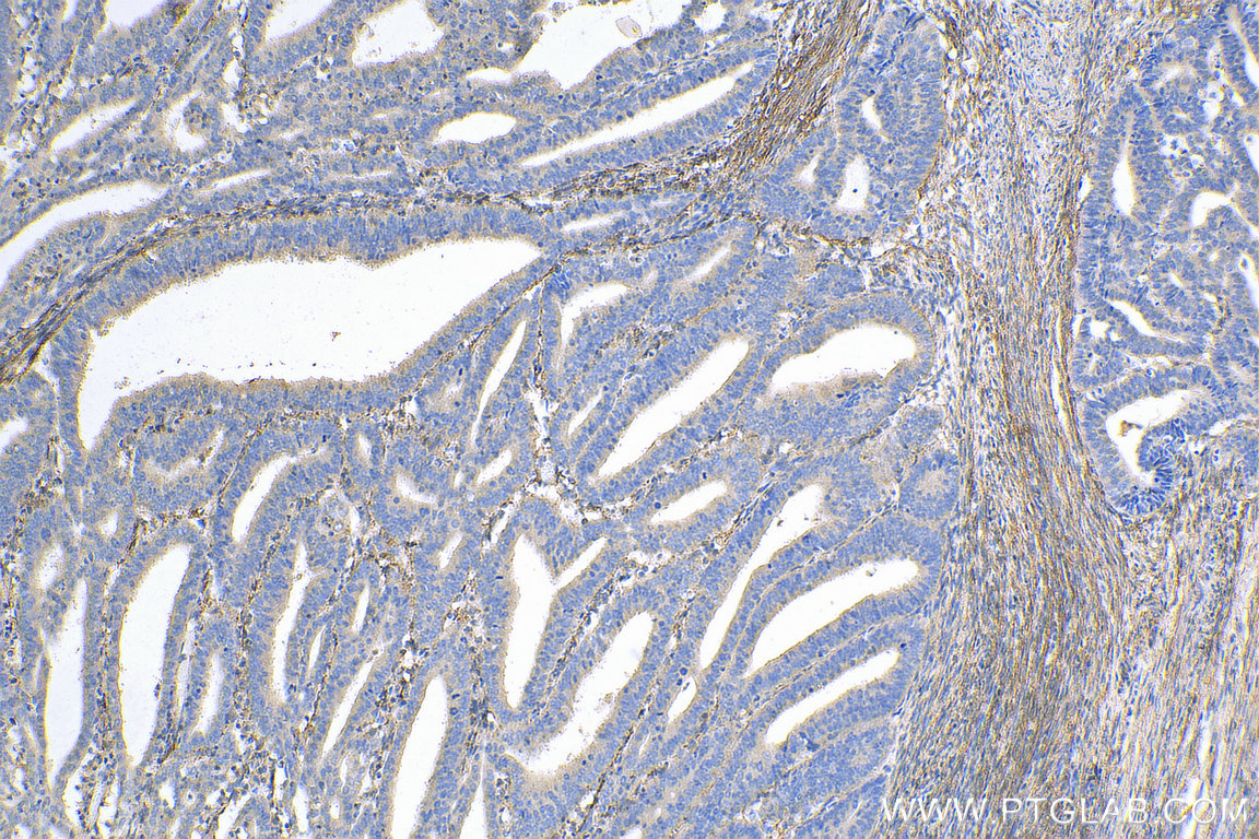 IHC staining of human endometrial cancer using 29425-1-AP (same clone as 29425-1-PBS)