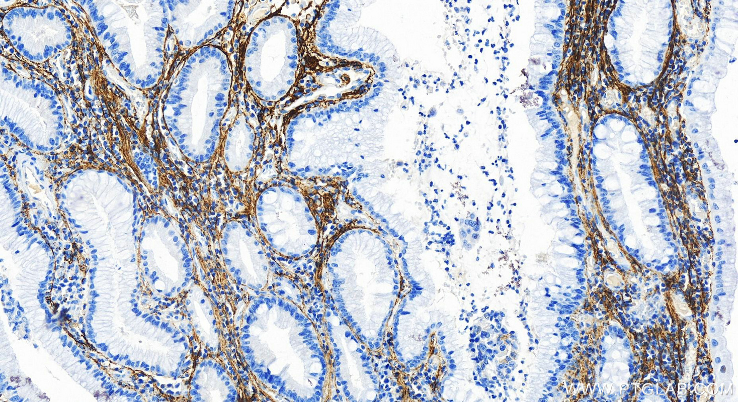 IHC staining of human stomach cancer using 83836-4-RR (same clone as 83836-4-PBS)