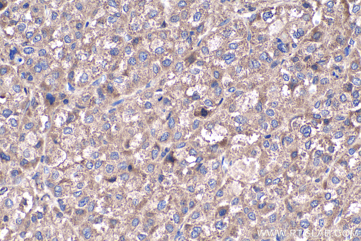 IHC staining of human liver cancer using 20645-1-AP