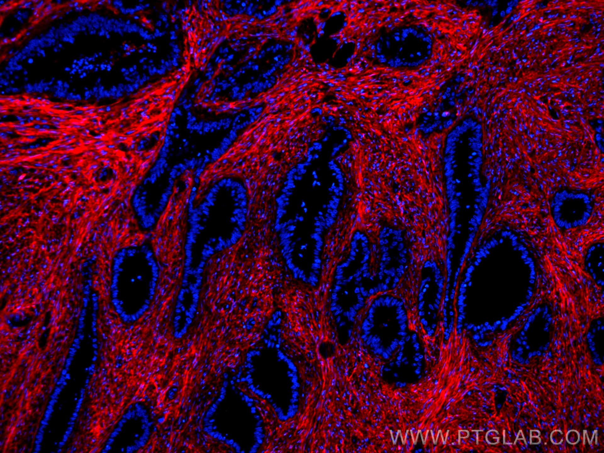 IF Staining of human colon cancer using CL594-66042