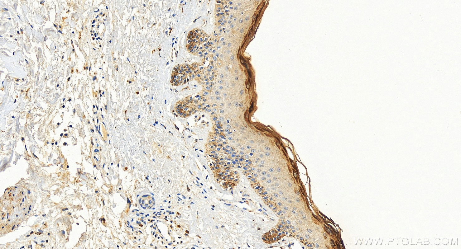 IHC staining of human paracancerous of skin squamous cell cancer using 26931-1-AP IHC staining of human paracancerous of skin squamous cell cancer using 26931-1-AP
