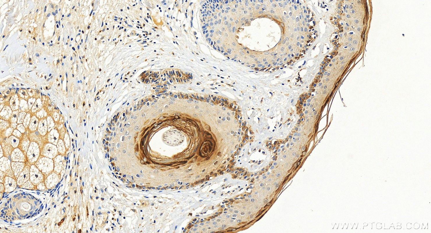 IHC staining of human paracancerous of skin squamous cell cancer using 26931-1-AP IHC staining of human paracancerous of skin squamous cell cancer using 26931-1-AP