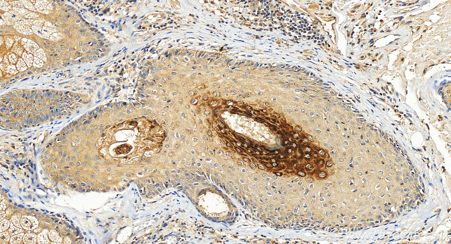 IHC staining of human skin squamous cell cancer using 26931-1-AP IHC staining of human skin squamous cell cancer using 26931-1-AP