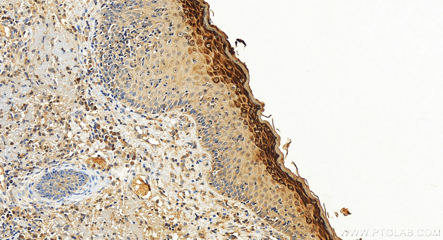 IHC staining of human skin squamous cell cancer using 26931-1-AP IHC staining of human skin squamous cell cancer using 26931-1-AP