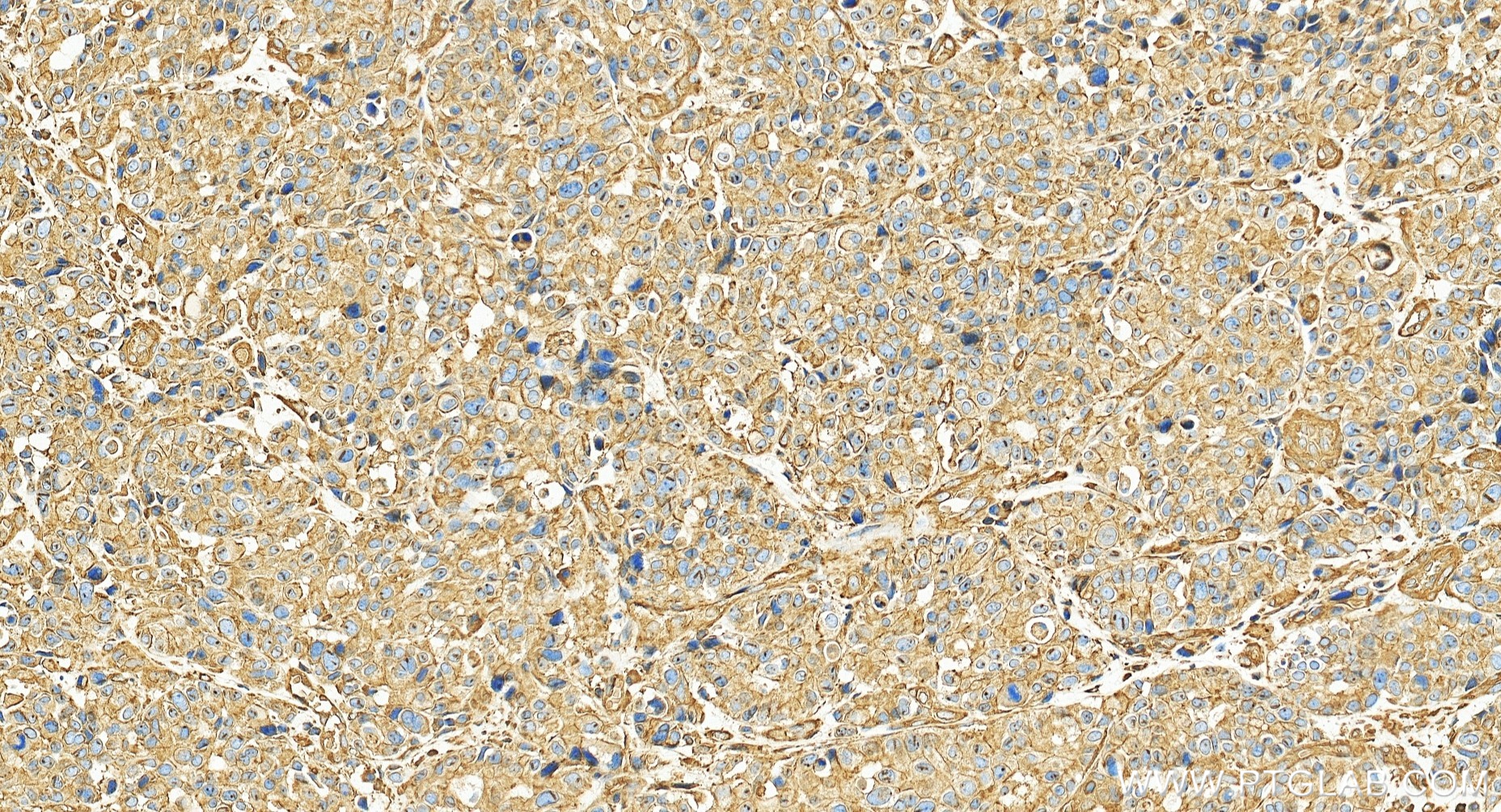 IHC staining of human stomach cancer using 86959-3-RR