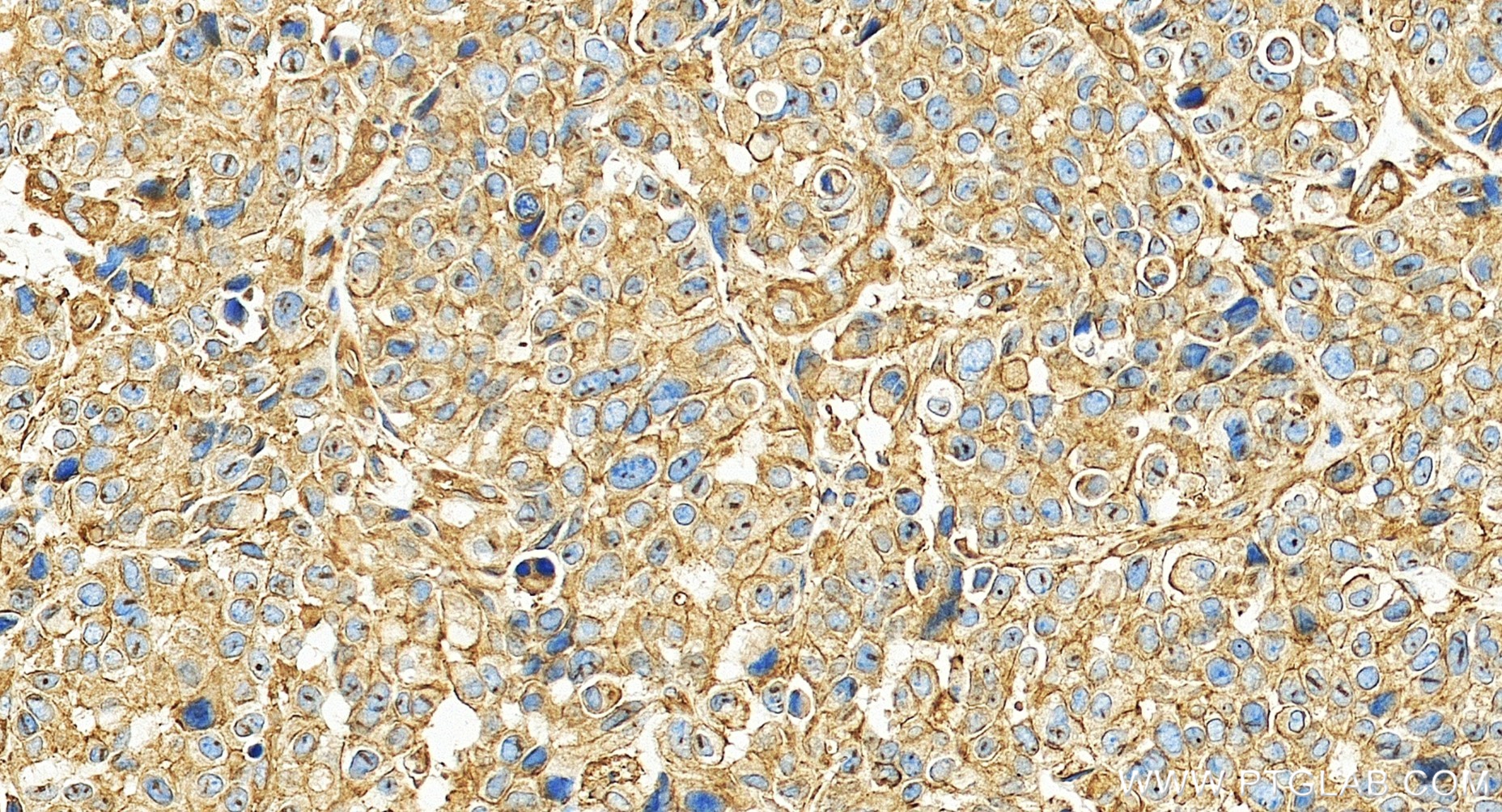 IHC staining of human stomach cancer using 86959-3-RR