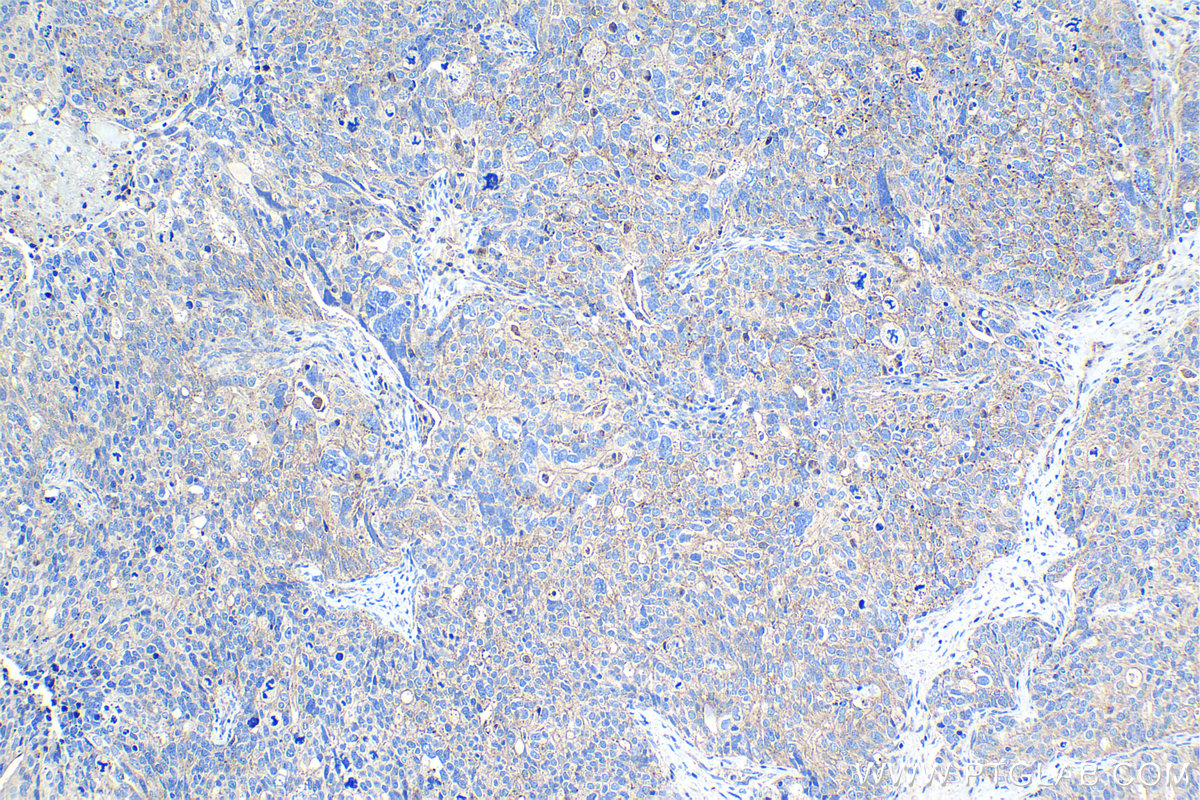 IHC staining of human ovary tumor using 67968-1-Ig (same clone as 67968-1-PBS)