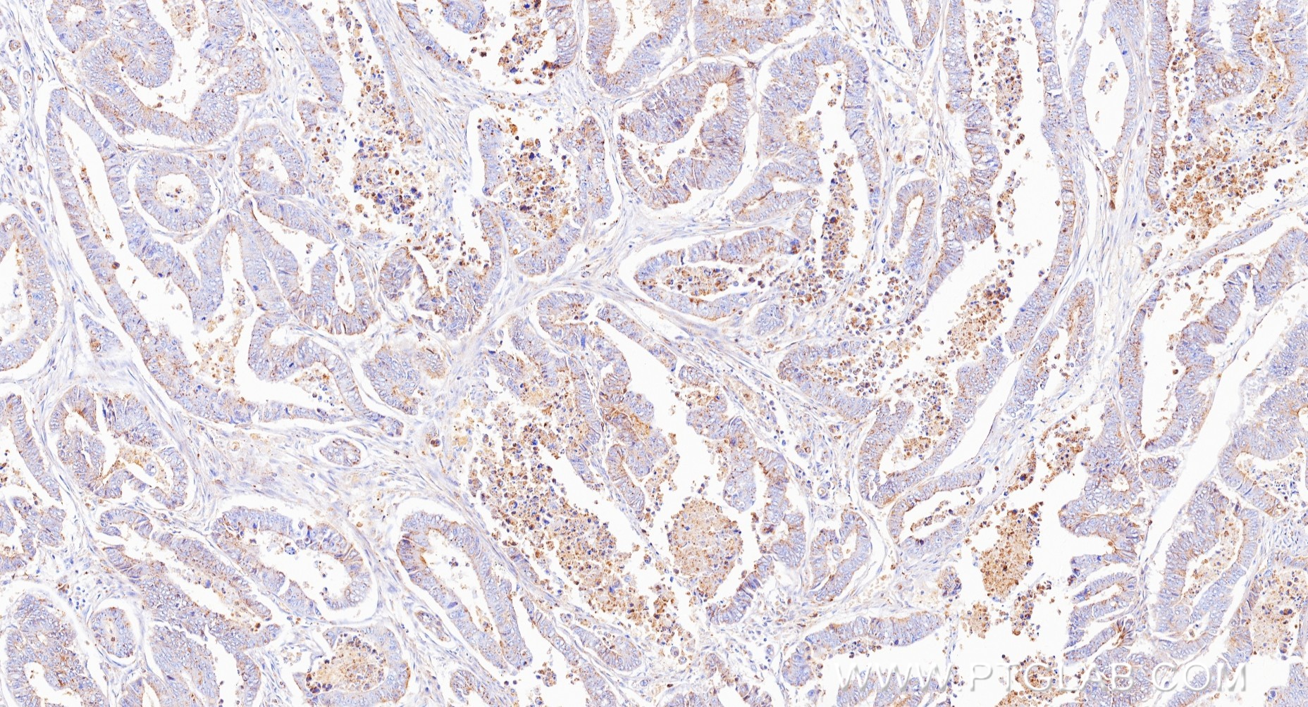 IHC staining of human colon cancer using 88149-1-RR IHC staining of human colon cancer using 88149-1-RR