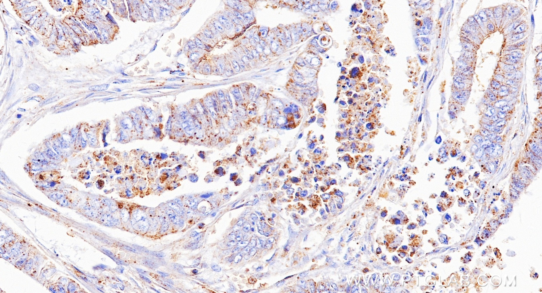 IHC staining of human colon cancer using 88149-1-RR IHC staining of human colon cancer using 88149-1-RR