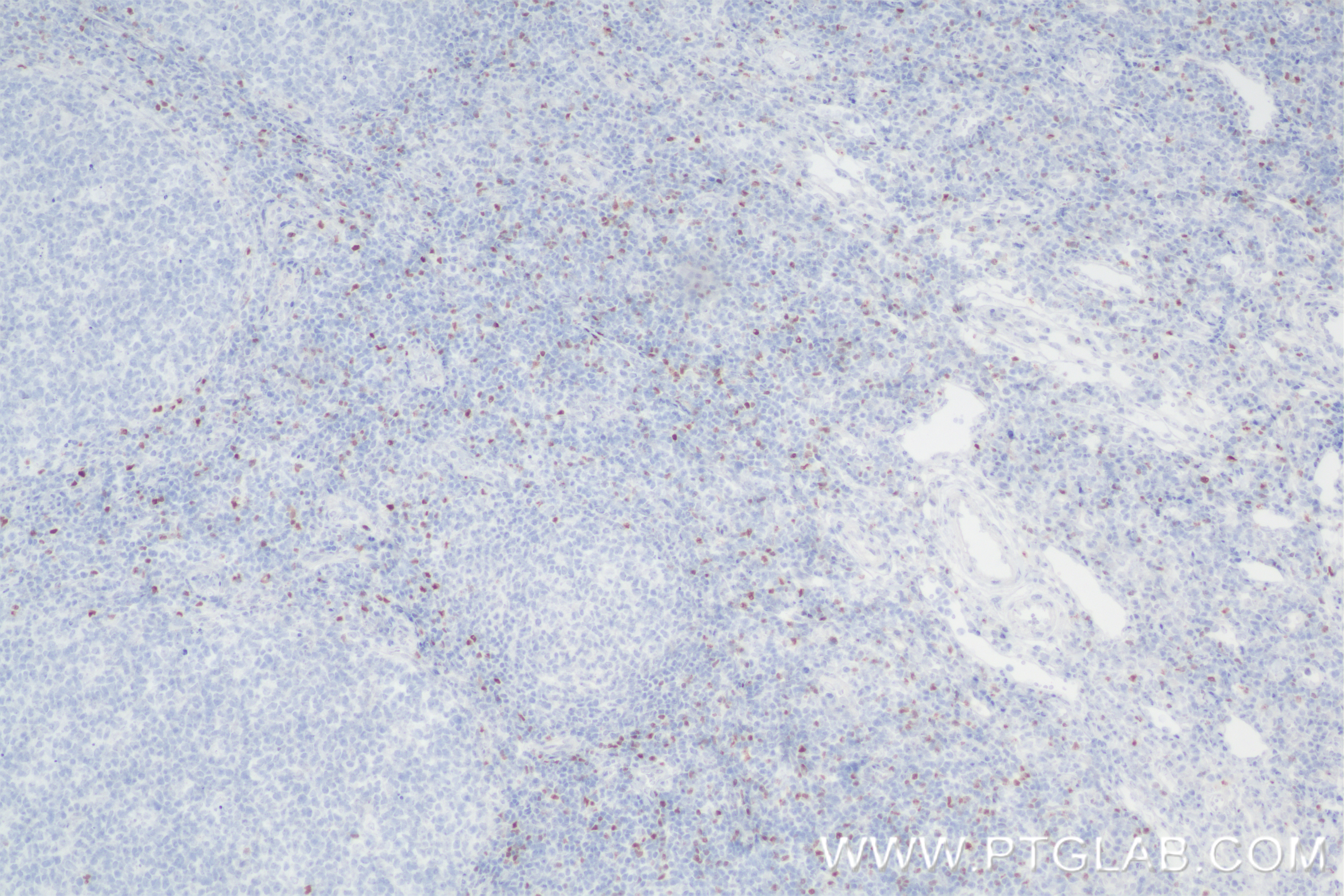 IHC staining of human tonsillitis using 85128-6-RR
