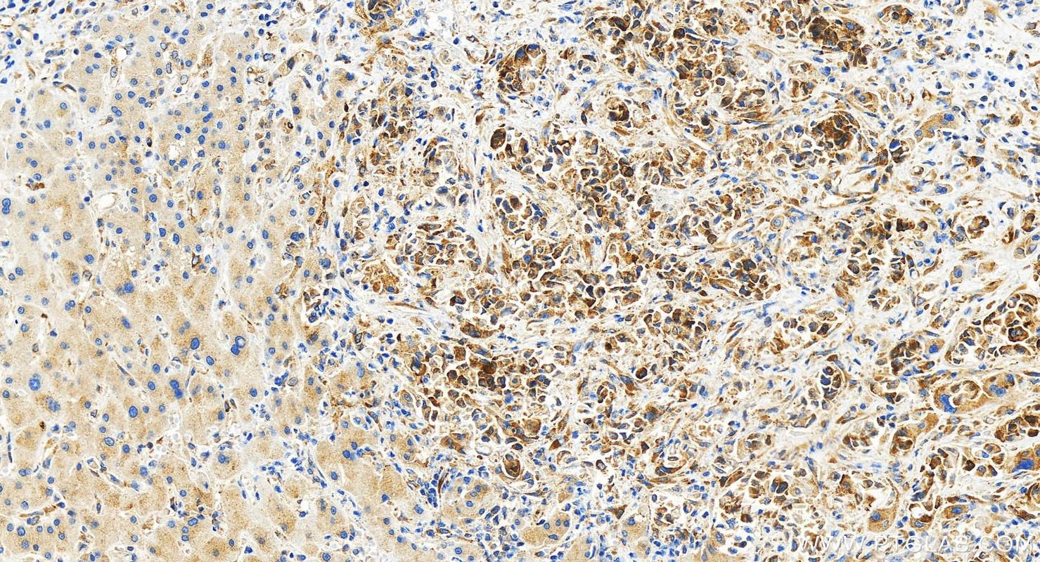 IHC staining of human intrahepatic cholangiocarcinoma using 82080-6-RR (same clone as 82080-6-PBS)