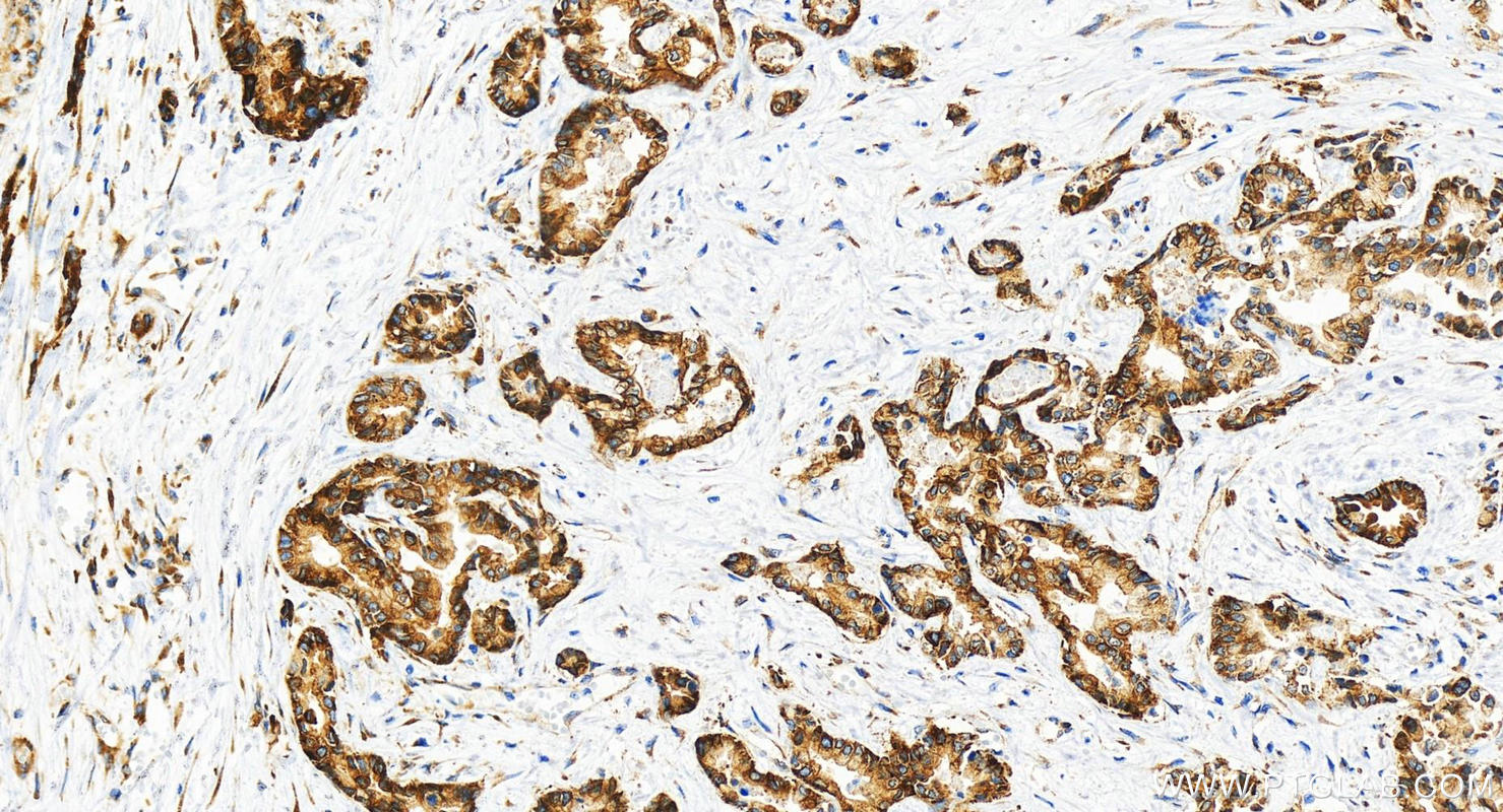 IHC staining of human intrahepatic cholangiocarcinoma using 82080-6-RR (same clone as 82080-6-PBS)