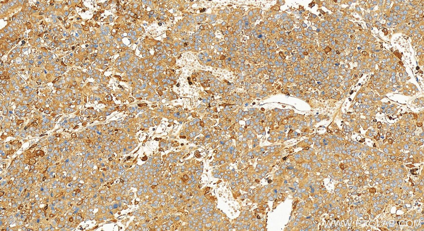Immunohistochemical analysis of paraffin-embedded human hepatocellular carcinoma slide using 25413-1-AP (G6PD antibody) at dilution of 1:1000 (under 20x lens). Heat mediated antigen retrieval with Tris-EDTA buffer (pH 9.0). IHC staining of human hepatocellular carcinoma using 25413-1-AP