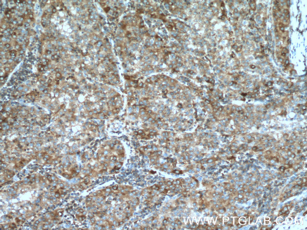 IHC staining of human liver cancer using 66373-1-Ig (same clone as 66373-1-PBS)