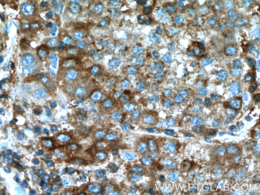IHC staining of human liver cancer using 66373-1-Ig (same clone as 66373-1-PBS)