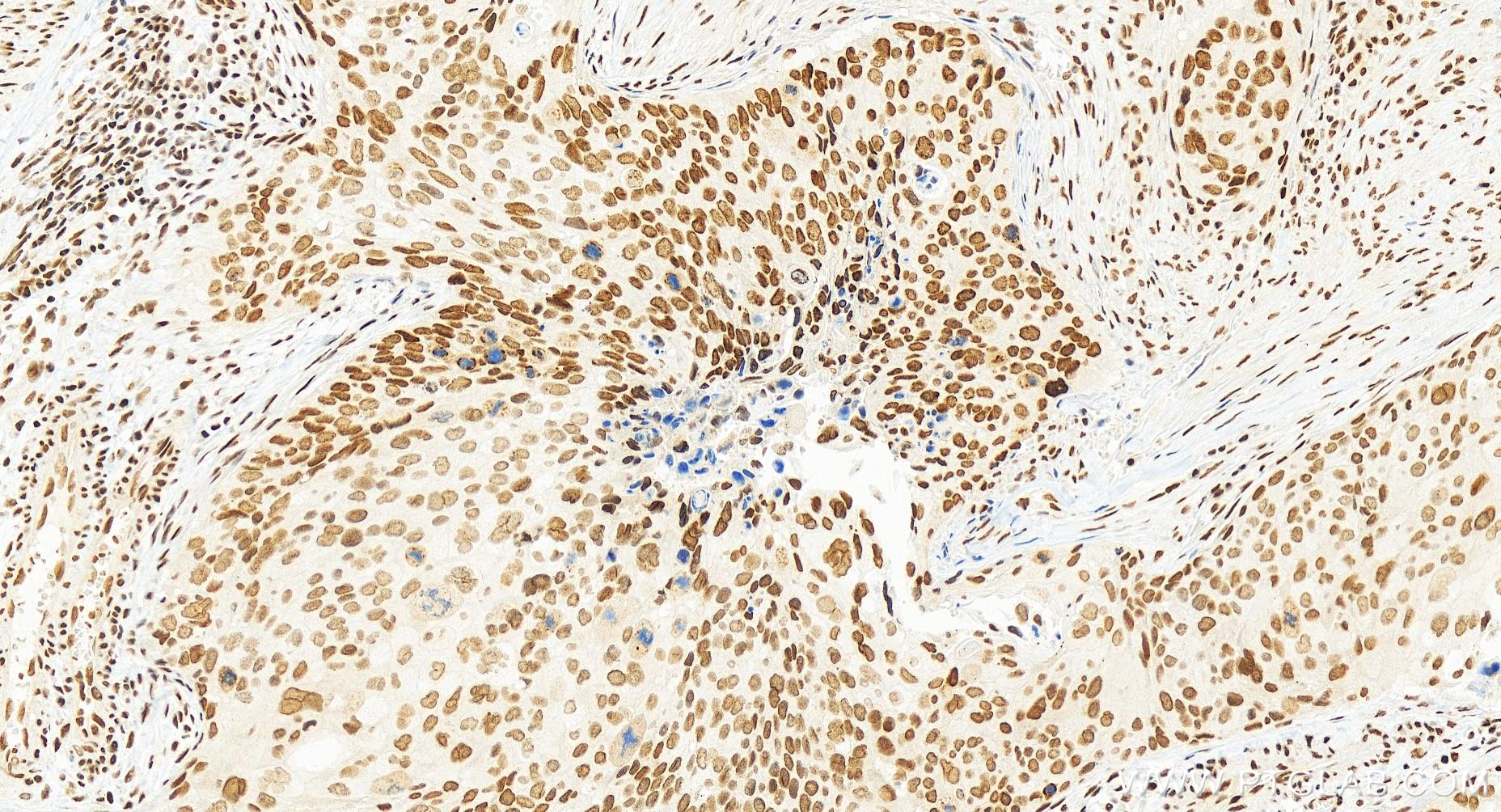 IHC staining of human cervical cancer using 84951-4-RR (same clone as 84951-4-PBS)