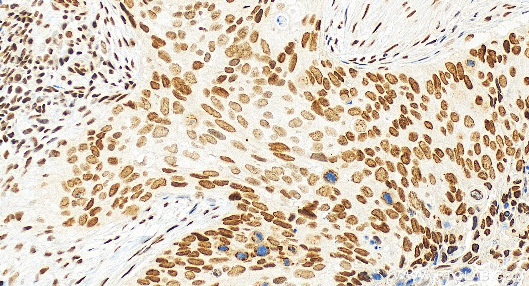 IHC staining of human cervical cancer using 84951-4-RR (same clone as 84951-4-PBS)
