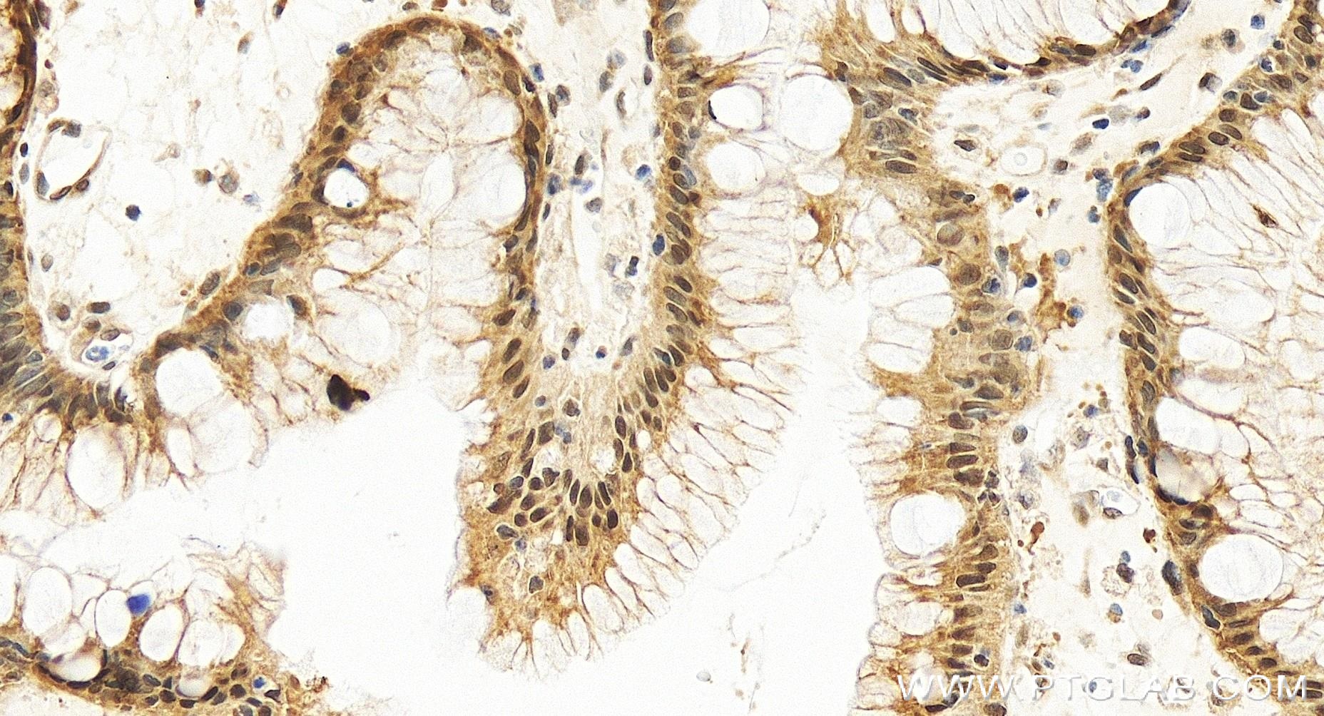 IHC staining of human stomach cancer using 84376-3-RR (same clone as 84376-3-PBS)