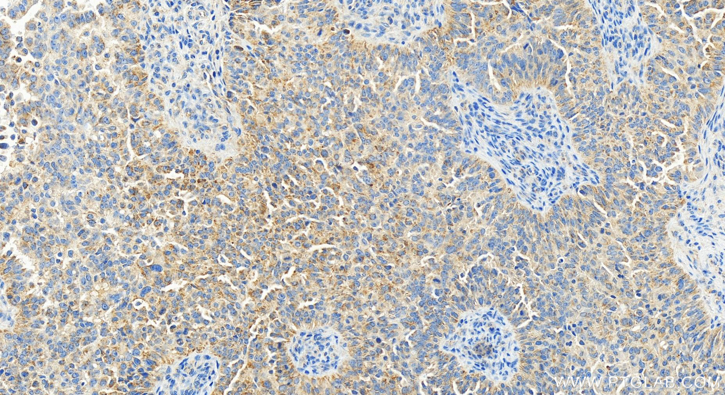 IHC staining of human ovarian  cancer using 83823-5-RR