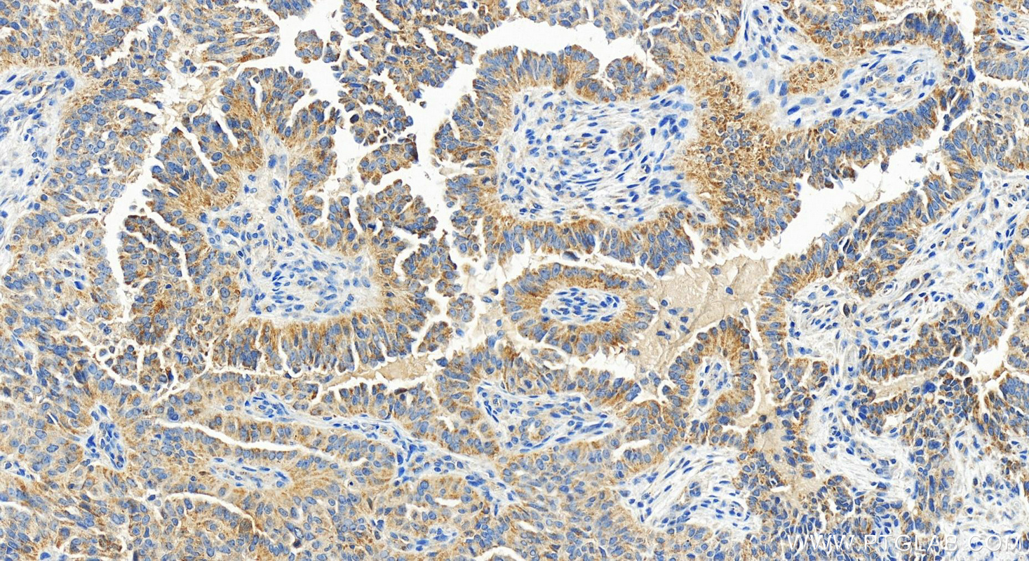 IHC staining of human ovarian  cancer using 83823-5-RR