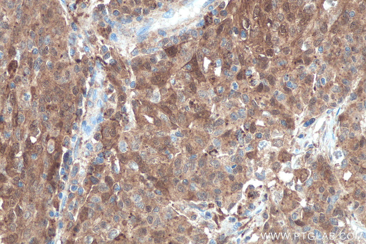 IHC staining of human stomach cancer using 60207-1-Ig IHC staining of human stomach cancer using 60207-1-Ig