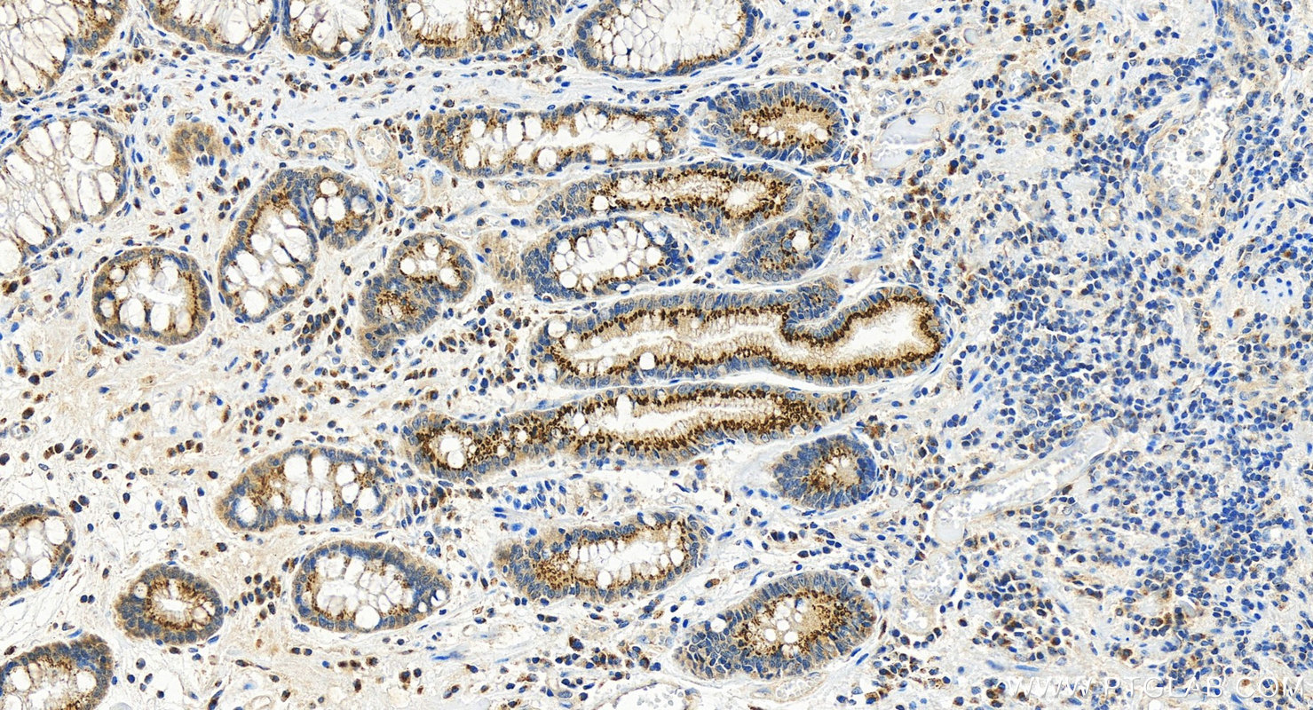 IHC staining of human stomach cancer using 13671-1-AP