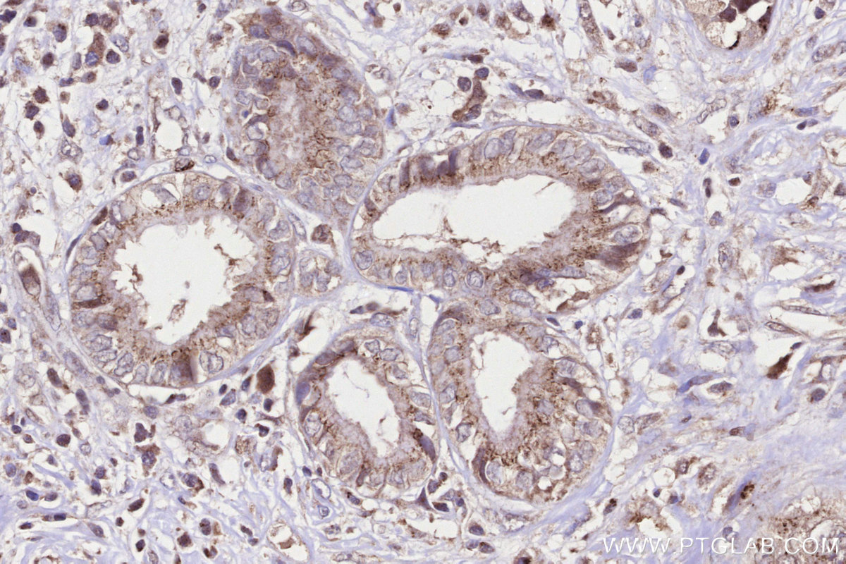 IHC staining of human pancreas cancer using 13671-1-AP