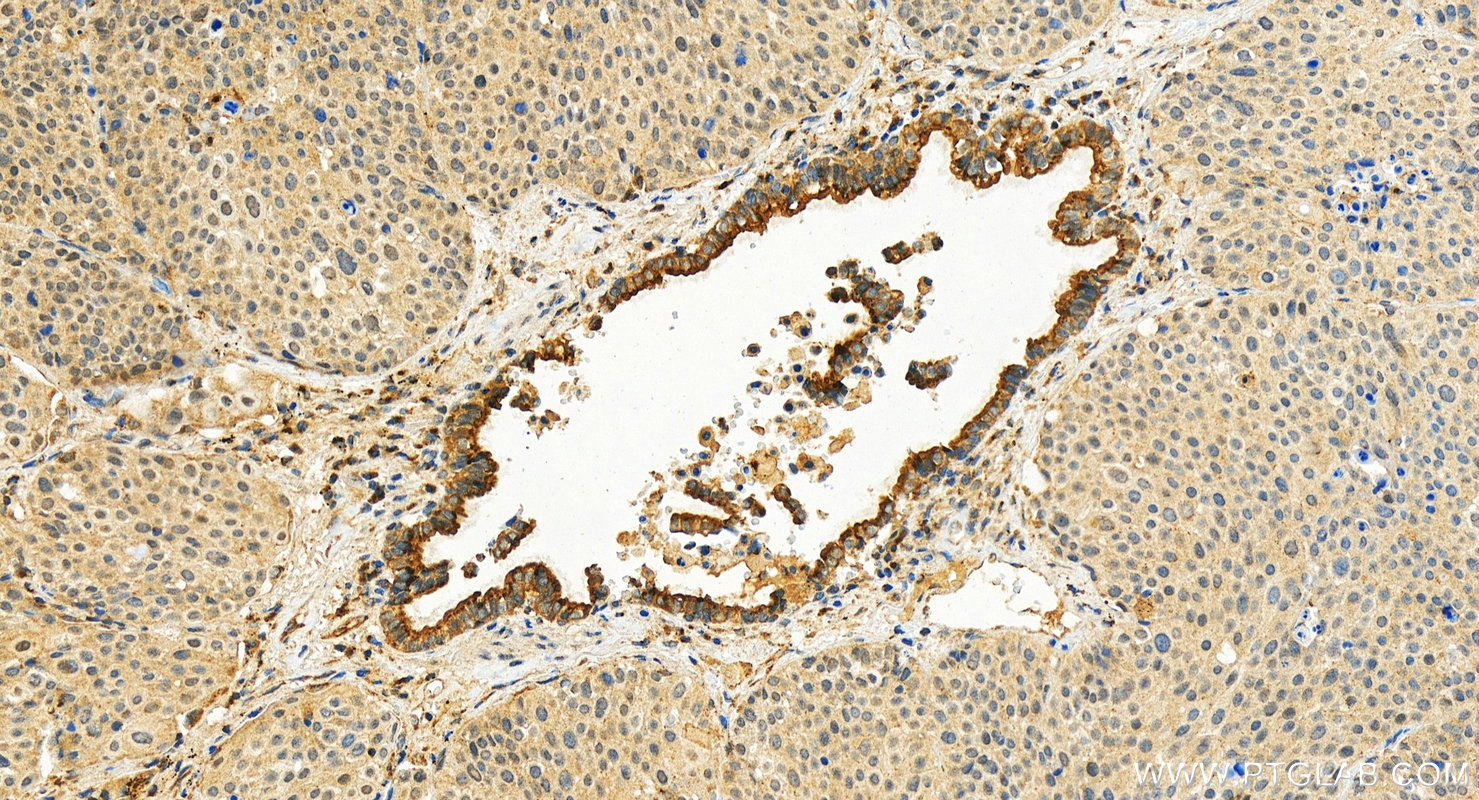 IHC staining of human lung squamous cell  cancer using 13671-1-AP