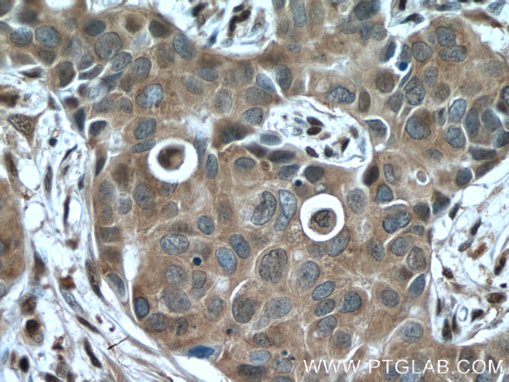 IHC staining of human breast cancer using 10494-1-AP